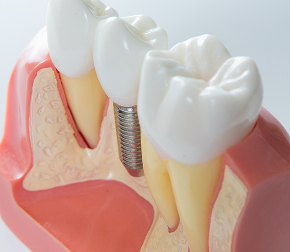 Close up of model of dental implant in Frankfort
