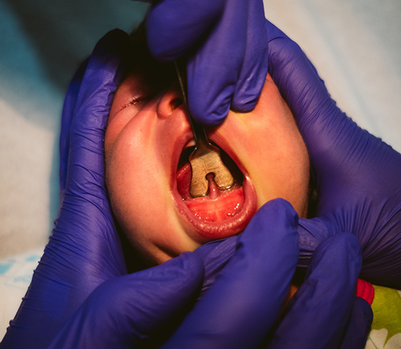 Opening child's mouth to look at tongue tie
