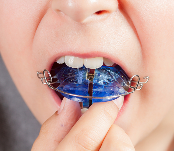 Putting in appliance for Phase 1 Orthodontics