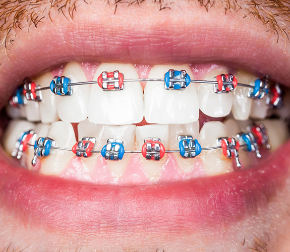 Close up of adult's smile with multicolored braces