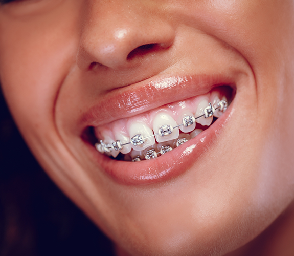 Showing off smile with metal braces