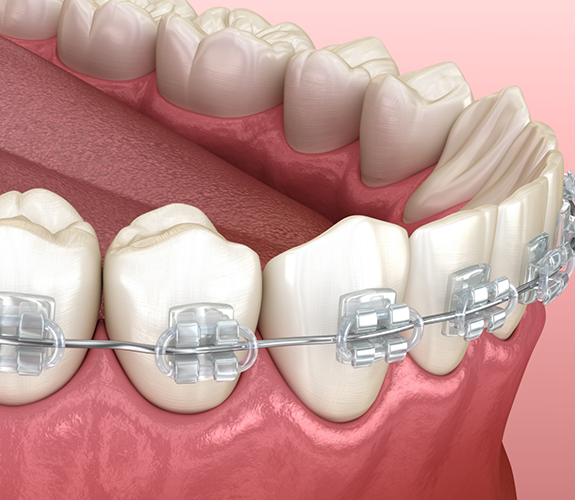 Illustration of tooth-colored braces for lower arch