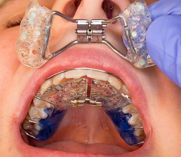 Opening mouth to show expanders