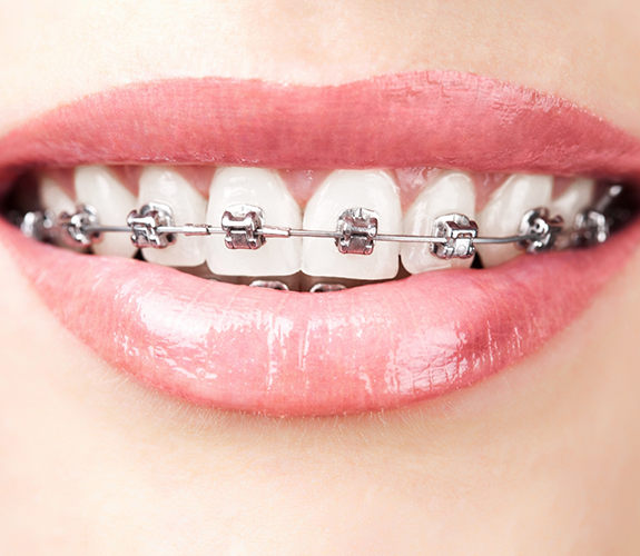 Close up of smile with LightForce braces