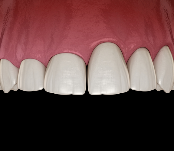 Illustration of uneven gumline