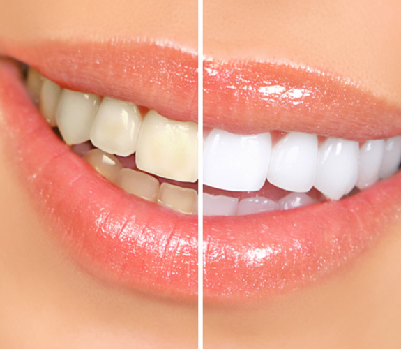 Side-by-side image of stained and whiter teeth
